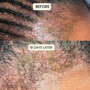 5 Microneedling Sessions (single area)